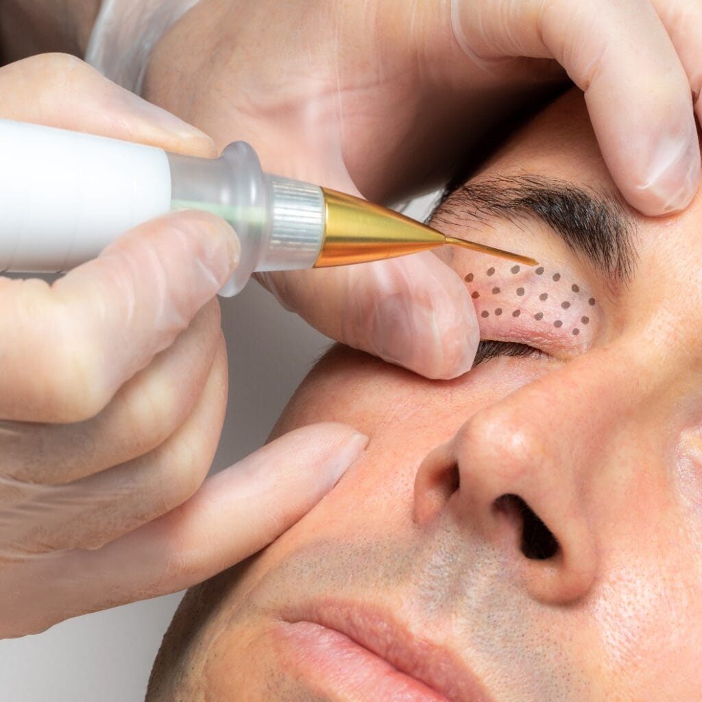 Middle aged man having laser plasma pen therapy on eyelids.